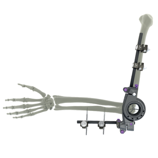 Ifix Elbow