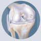IMD Mosaicplasty