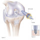 IMD Mosaicplasty