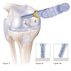 IMD Mosaicplasty