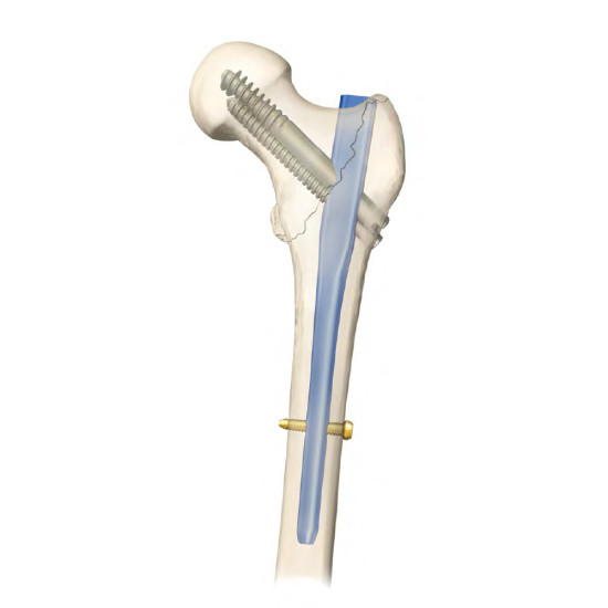 PFN Nail - Proximal Femoral Nail