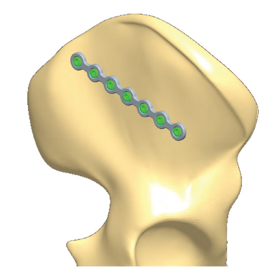 Pelvis Plates