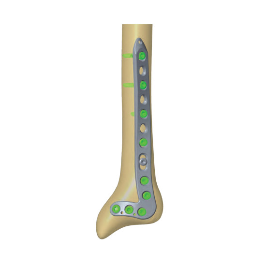 Ant Lat Dis Tibia+