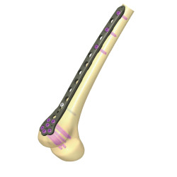 Distal Femur