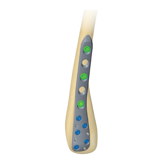 Fibula Plate