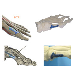 Metatarsal Plate