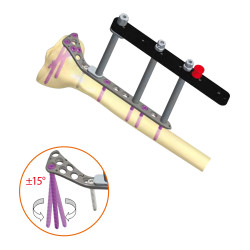 Proximal Tibia