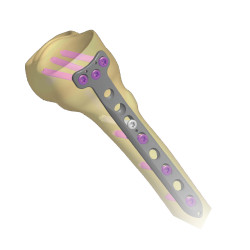 Proximal Tibia Medial
