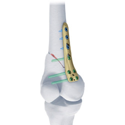 Tomfix Femur Osteotomy
