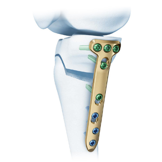 Tomfix Tibia Osteotomy